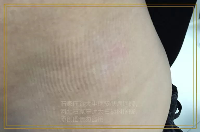 白癜风长在脚背上如何治疗效果好