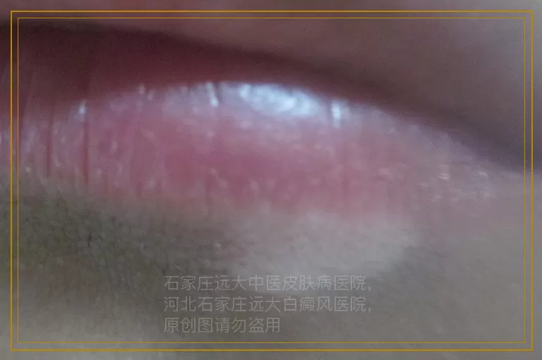 白癜风照308会变大吗