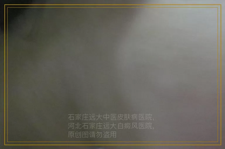 白癜风真的治不好了吗