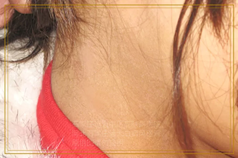 白癜风照308多久后白斑才能恢复