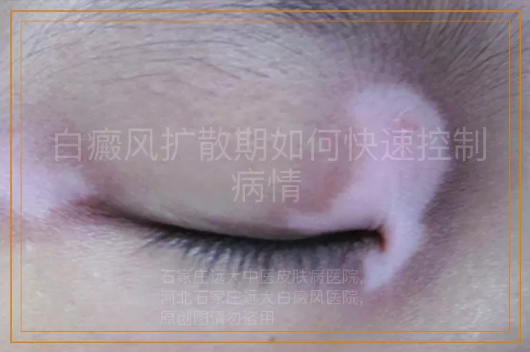 白癜风扩散期如何快速控制病情