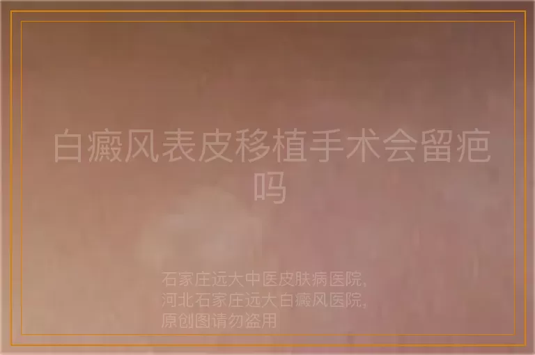 白癜风表皮移植手术会留疤吗