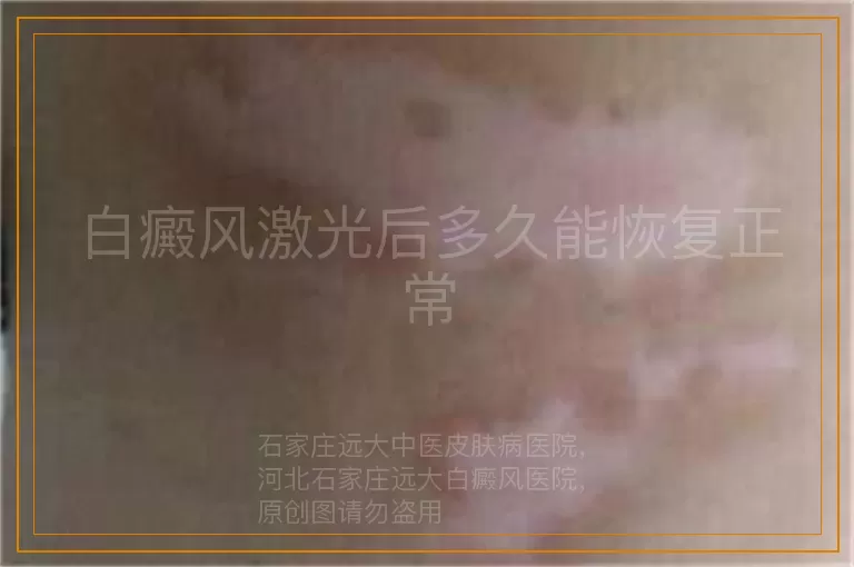 白癜风激光后多久能恢复正常