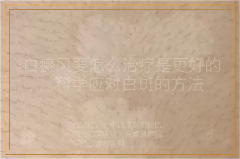 白癜风要怎么治疗是更好的，科学应对白斑的方法