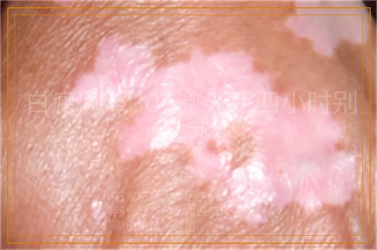 白癜风照308激光后四小时别沾水