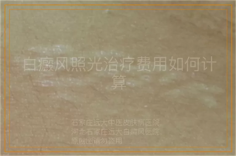 白癜风照光治疗费用如何计算