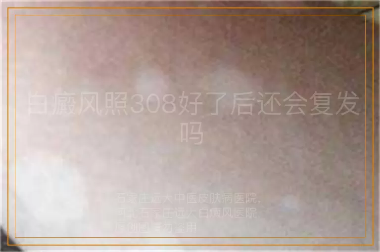 白癜风照308好了后还会复发吗