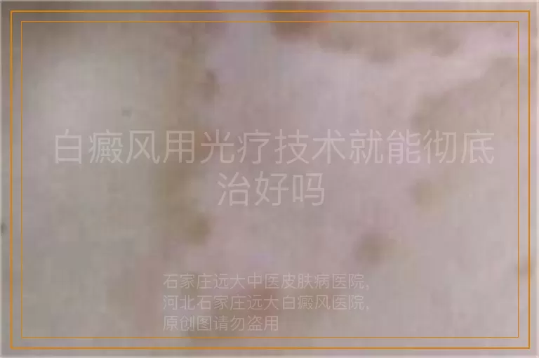 白癜风用光疗技术就能彻底治好吗