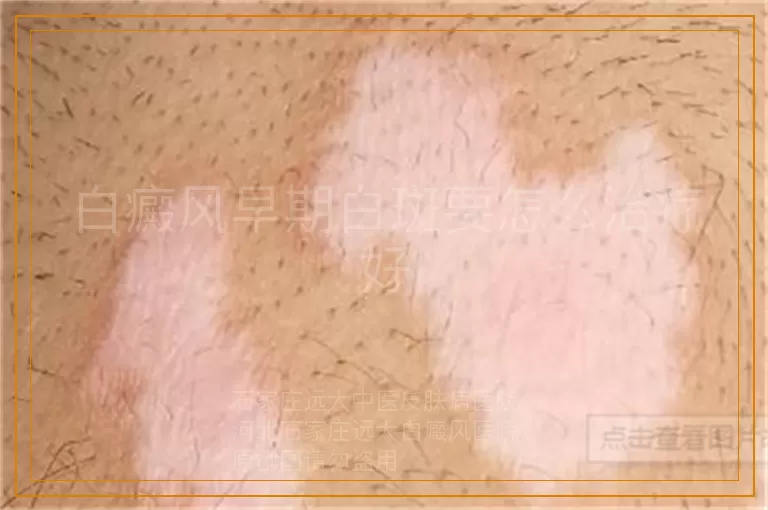 白癜风早期白斑要怎么治疗好