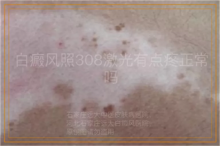 白癜风照308激光有点疼正常吗