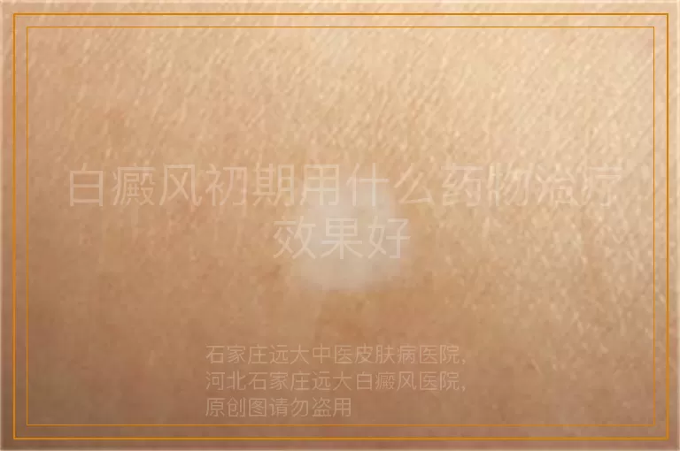 白癜风初期用什么药物治疗效果好
