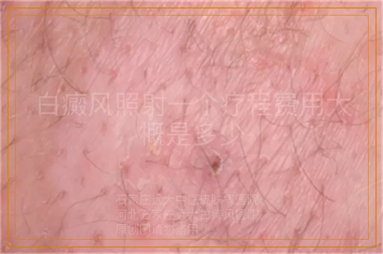白癜风照射一个疗程费用大概是多少