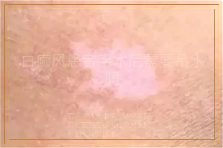 白癜风患者手术后需要吊水吗