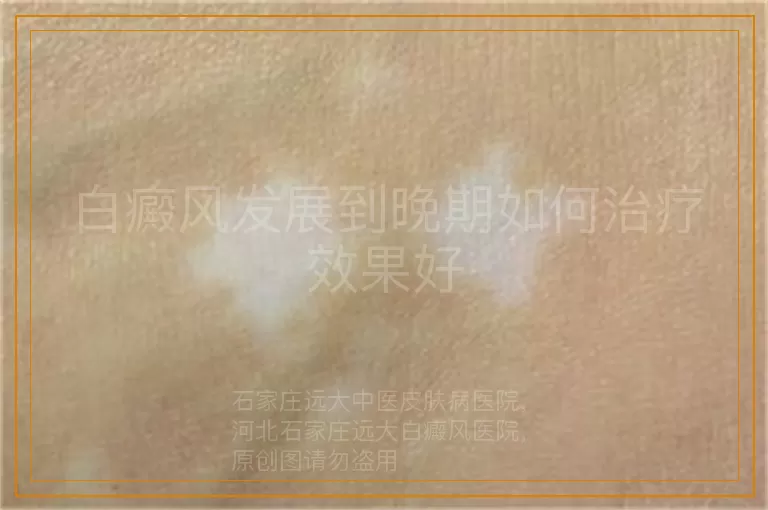 白癜风发展到晚期如何治疗效果好
