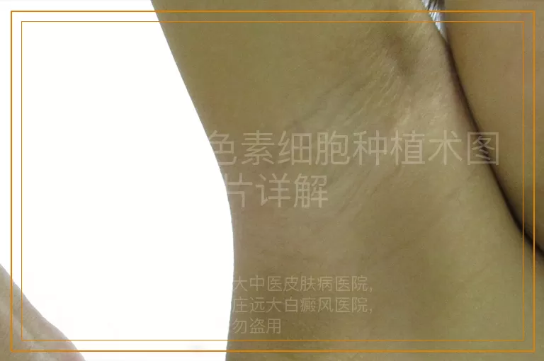白癜风黑色素细胞种植术图片详解