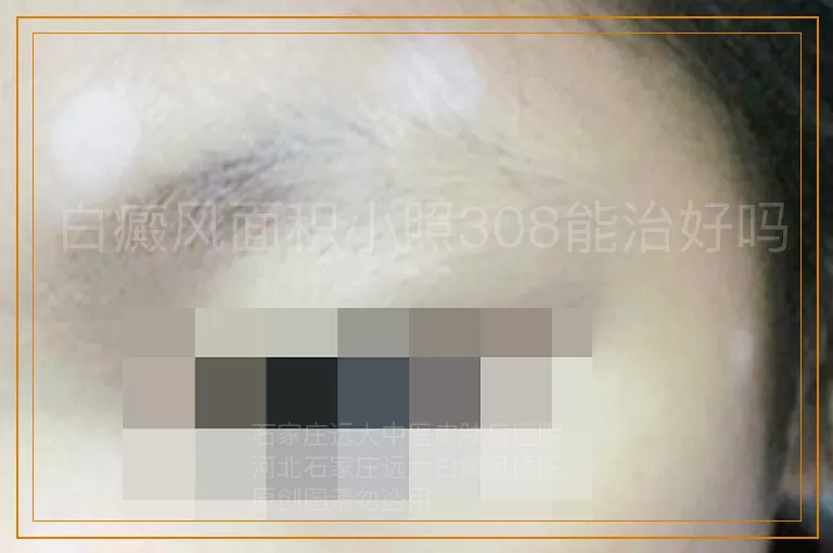 白癜风面积小照308能治好吗