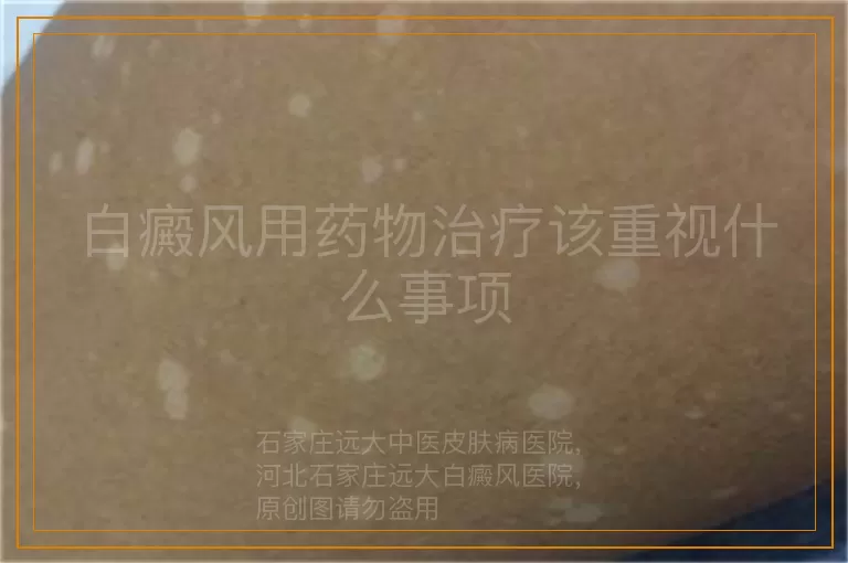 白癜风用药物治疗该重视什么事项