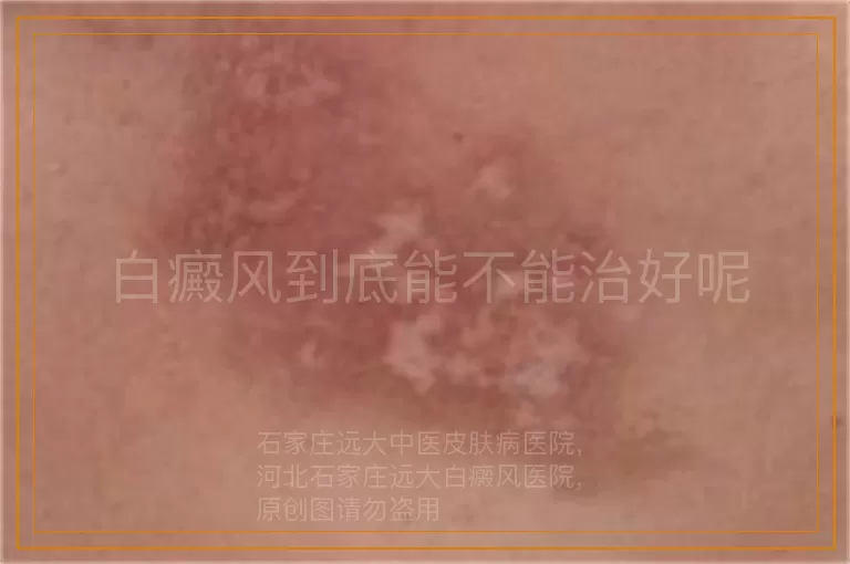 白癜风到底能不能治好呢