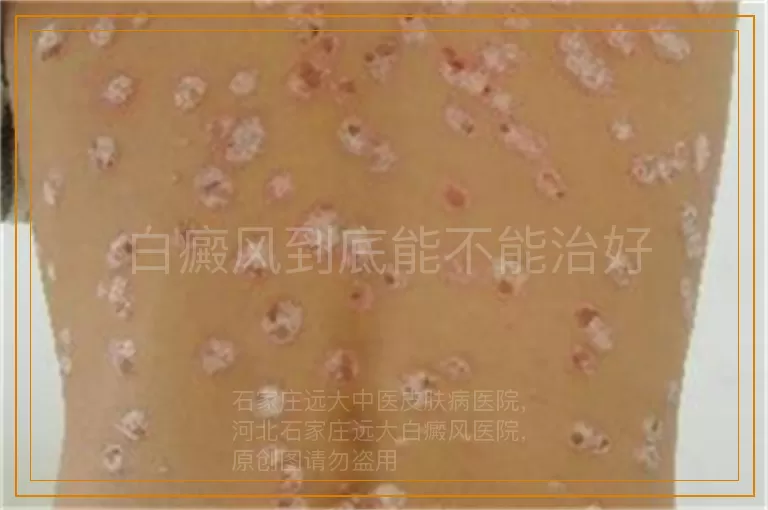 白癜风到底能不能治好