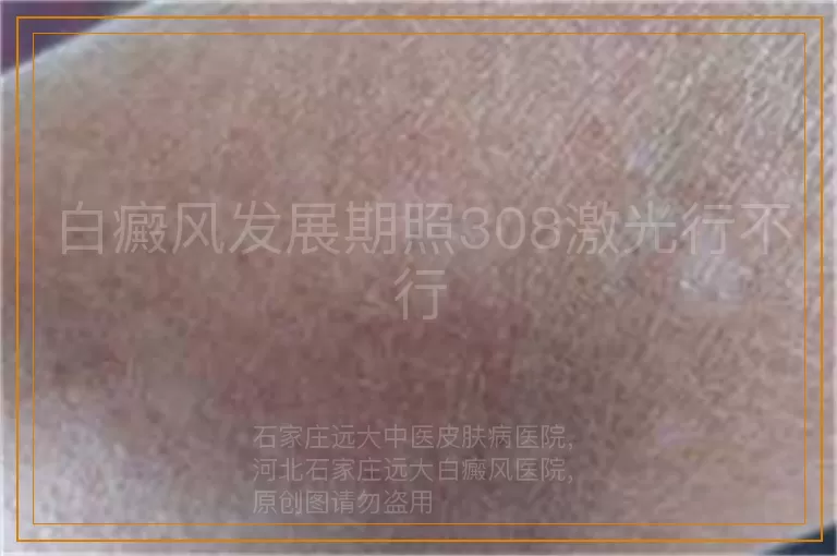 白癜风发展期照308激光行不行