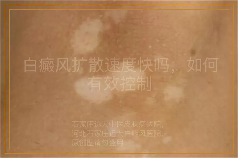 白癜风扩散速度快吗，如何有效控制