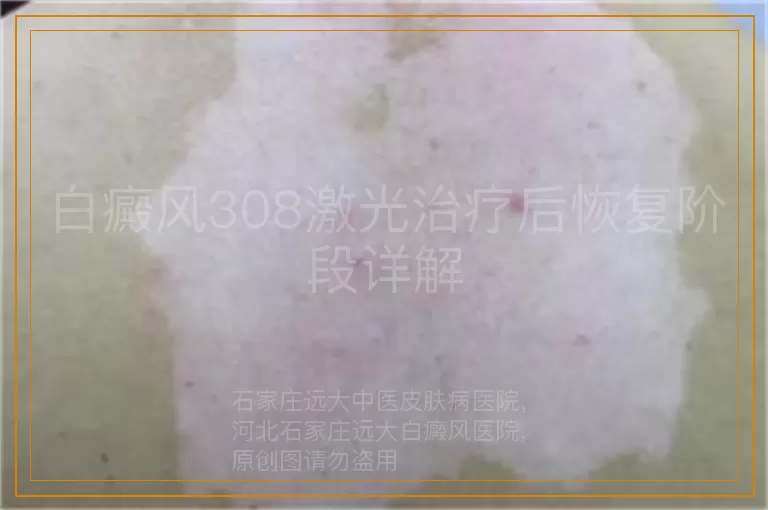 白癜风308激光治疗后恢复阶段详解