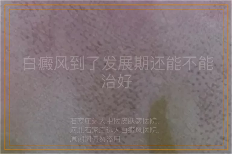 白癜风到了发展期还能不能治好