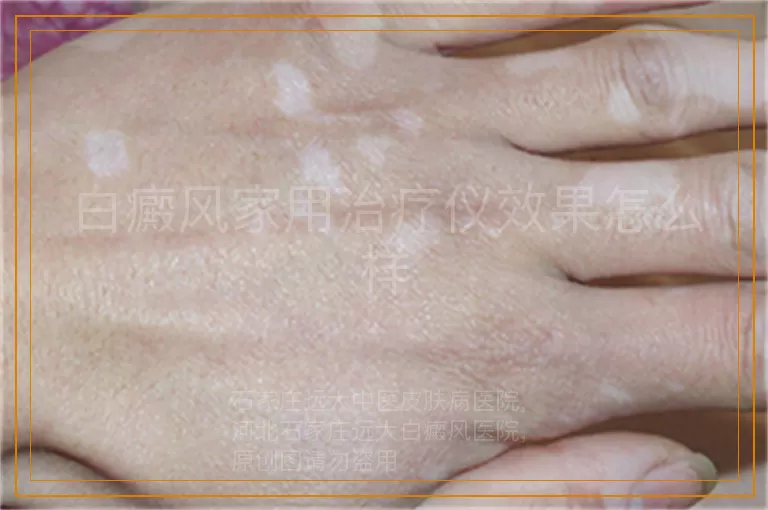 白癜风家用治疗仪效果怎么样