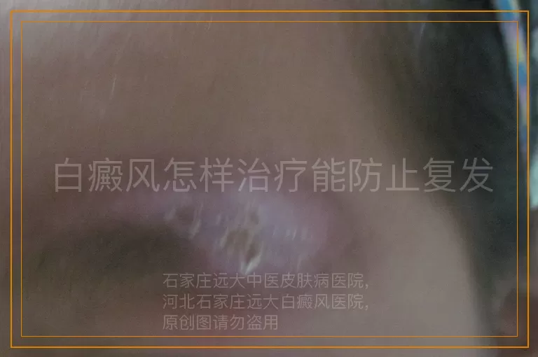 白癜风怎样治疗能防止复发