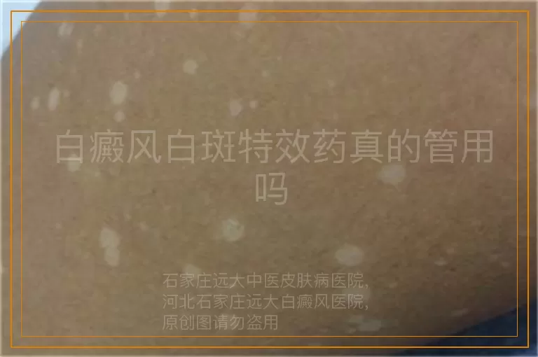 白癜风白斑特效药真的管用吗
