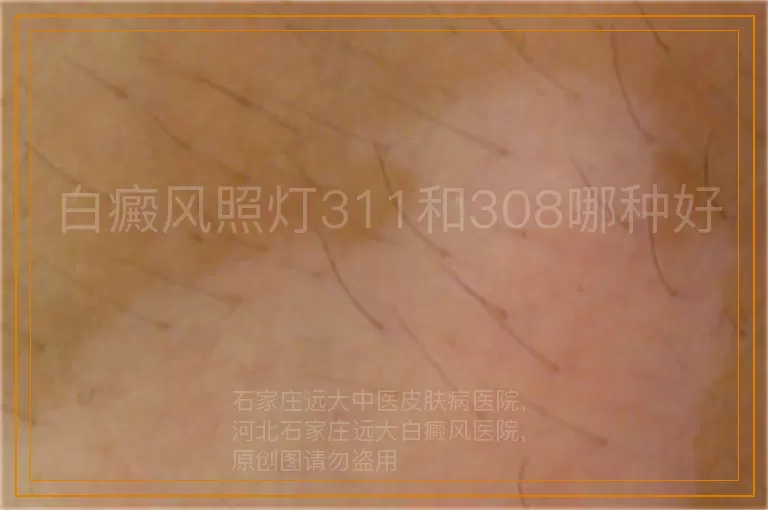 白癜风照灯311和308哪种好