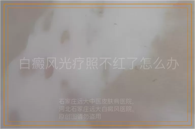 白癜风光疗照不红了怎么办
