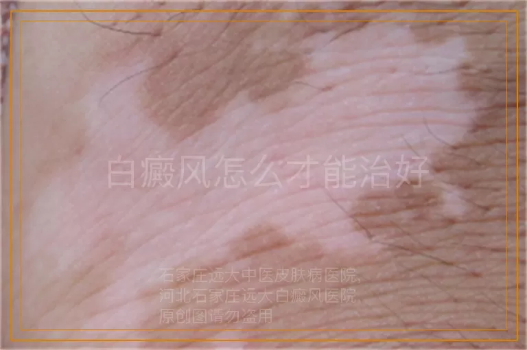 白癜风怎么才能治好