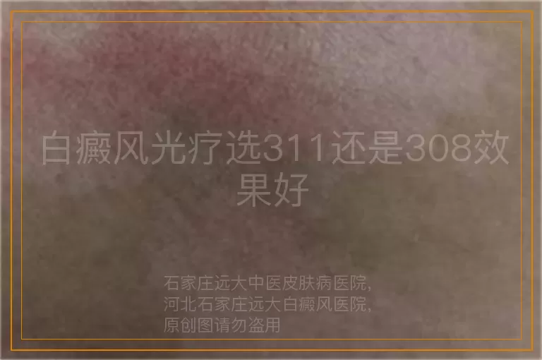 白癜风光疗选311还是308效果好