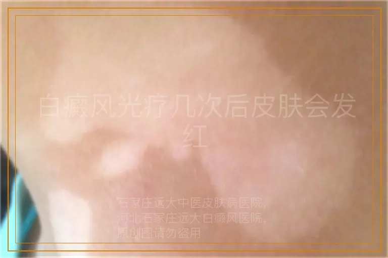 白癜风光疗几次后皮肤会发红