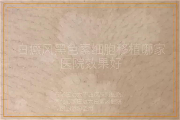 白癜风黑色素细胞移植哪家医院效果好