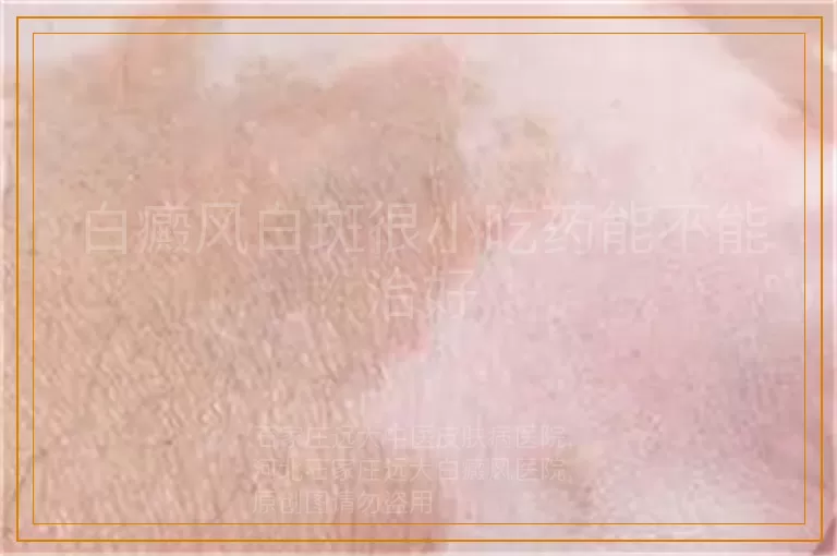 白癜风白斑很小吃药能不能治好