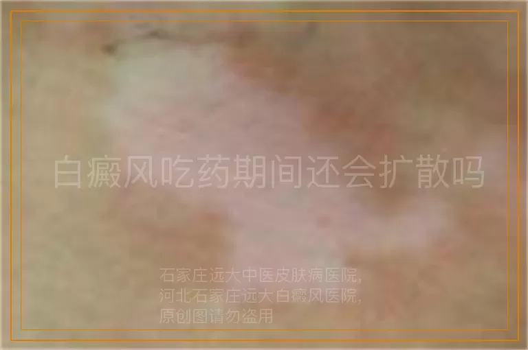 白癜风吃药期间还会扩散吗