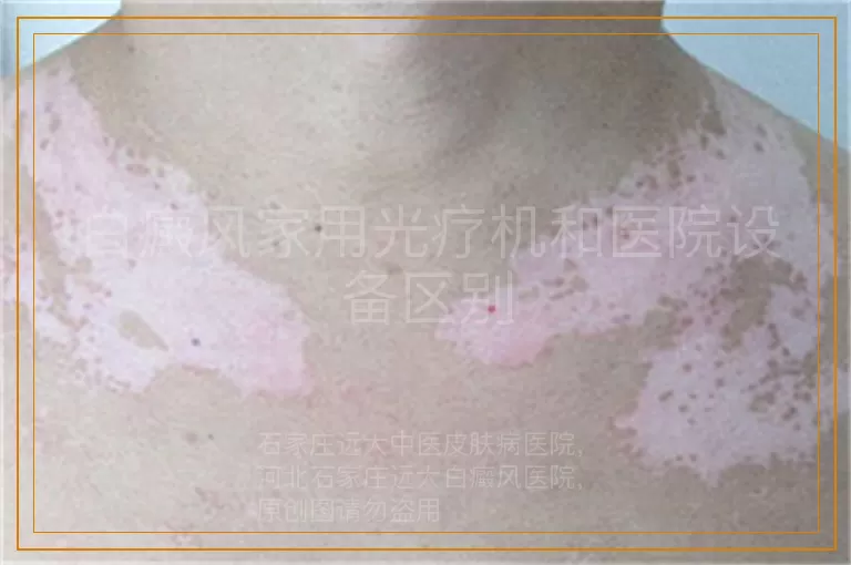 白癜风家用光疗机和医院设备区别