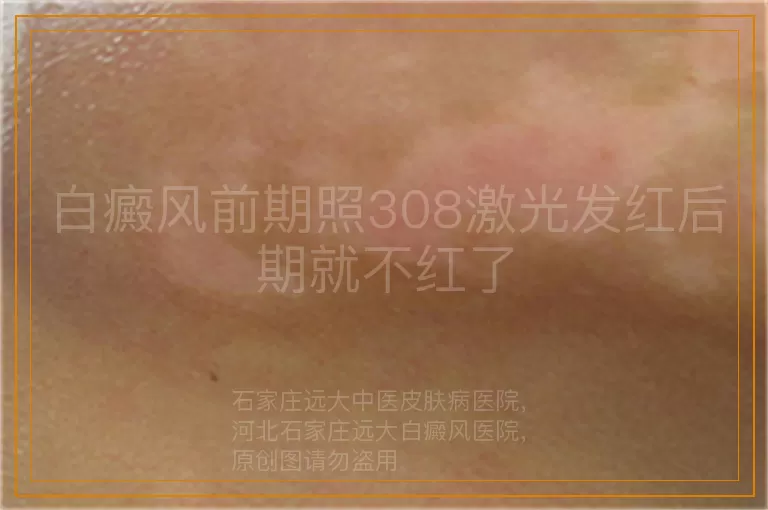 白癜风前期照308激光发红后期就不红了