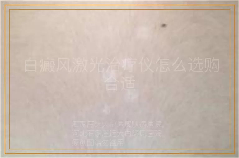 白癜风激光治疗仪怎么选购合适