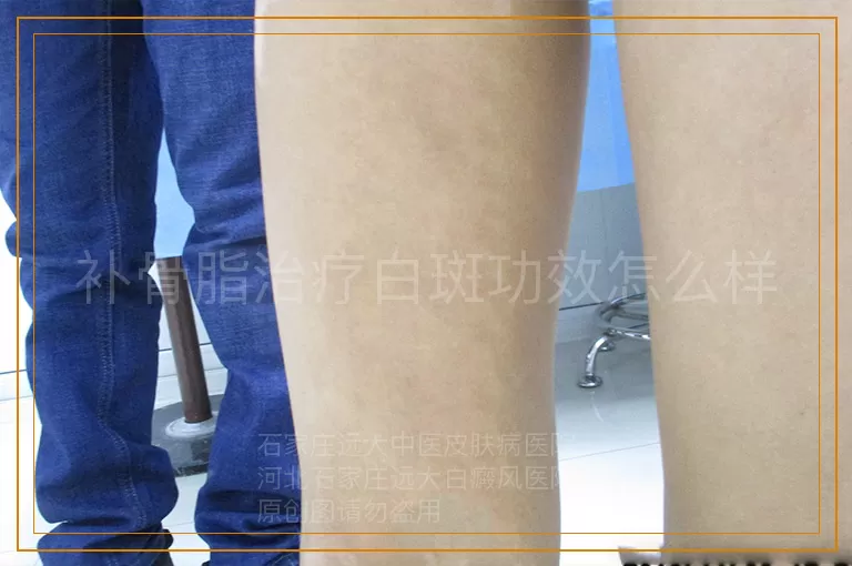 补骨脂治疗白斑功效怎么样