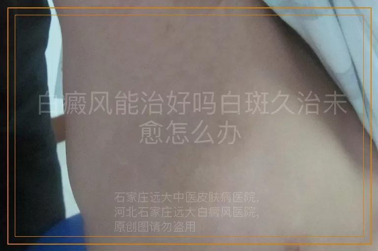 白癜风能治好吗白斑久治未愈怎么办