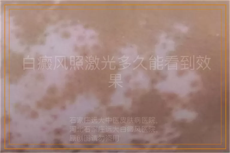 白癜风照激光多久能看到效果