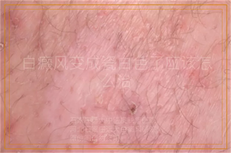白癜风变成瓷白色了应该怎么治