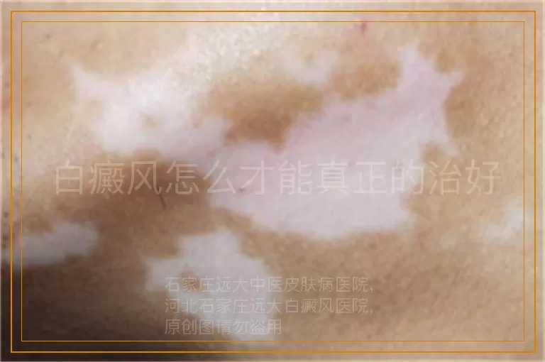 白癜风怎么才能真正的治好