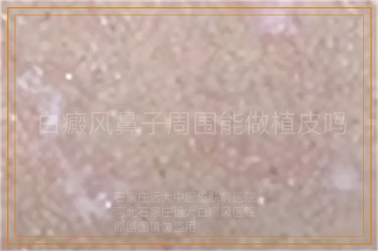 白癜风鼻子周围能做植皮吗