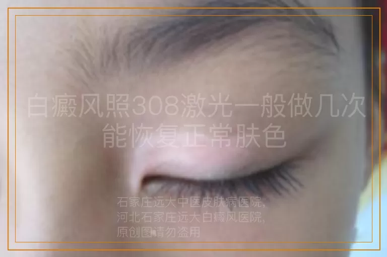 白癜风照308激光一般做几次能恢复正常肤色