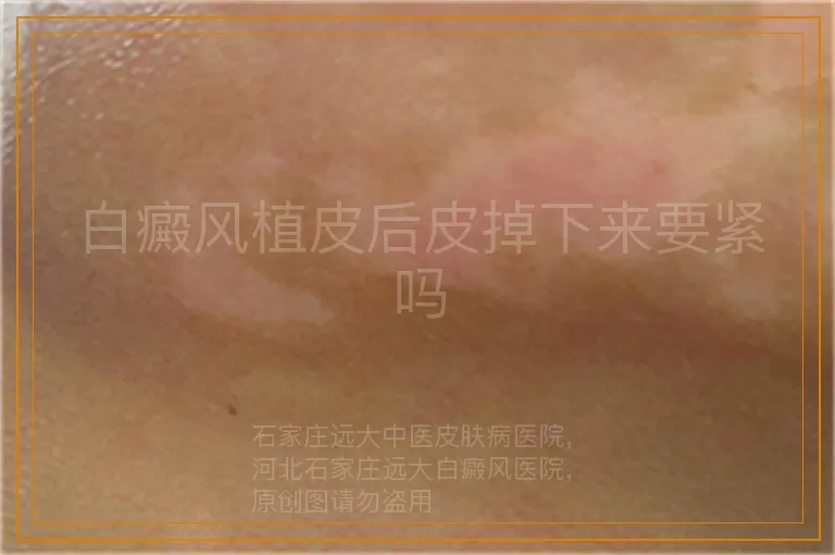 白癜风植皮后皮掉下来要紧吗