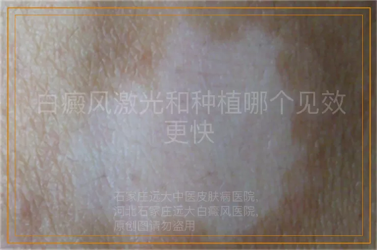 白癜风激光和种植哪个见效更快